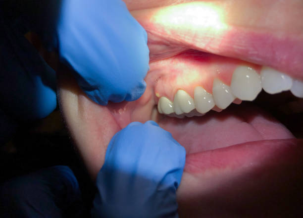 Best Emergency Dentist for Lost Fillings or Crowns in Jupiter Farms, FL